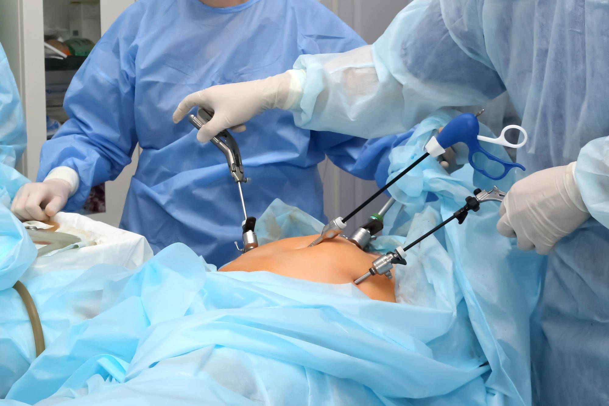 Laparoscopic Surgery Procedure - Banner Image
