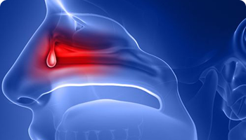 Medical illustration of a human nasal cavity showing inflammation and a drop representing mucus or discharge.