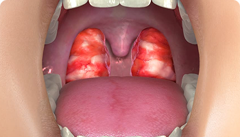 Medical illustration showing a close-up view of an inflamed throat with red, swollen tonsils covered in white patches