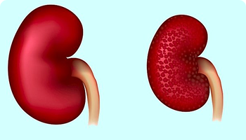 healthy vs. diseased kidney