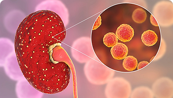 Illustration of an infected kidney with a magnified view showing bacteria or pathogens, representing a bacterial kidney infection.