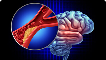 Stroke or brain artery blockage