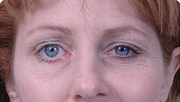 Woman with uneven eye appearance