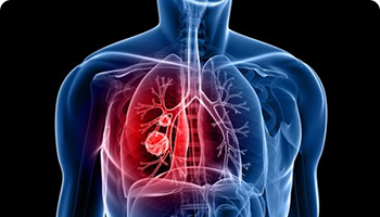 X-ray style image of a human upper body showing lungs, with a highlighted red area indicating a tumor or inflammation in the left lung.
