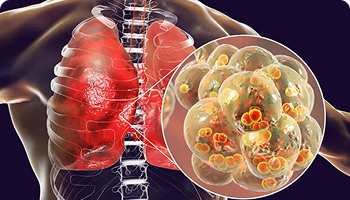 3D medical illustration of inflamed lungs inside a human torso, with a close-up of infected cells