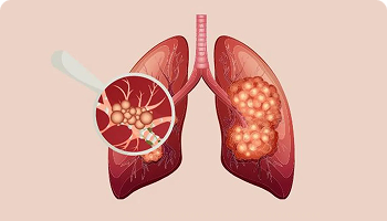 Illustration of human lungs with a magnified view showing cancerous cells in both lungs, highlighting areas affected by tumors.