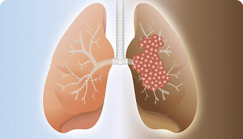 Illustration of human lungs showing cancerous growth in the right lung, with tumor cells visibly spreading through the lung tissue.