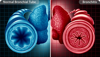 Comparison image showing a normal bronchial tube on the left and an inflamed bronchial tube with thickened walls on the right, labeled as bronchitis.