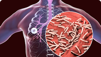 Medical illustration showing tuberculosis infection in the lungs, with a close-up of rod-shaped TB bacteria affecting the lung tissue.