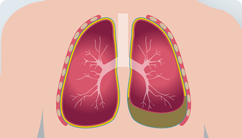 Medical illustration showing pleural effusion, with fluid buildup in the lower area of the right lung between the lung and chest wall.
